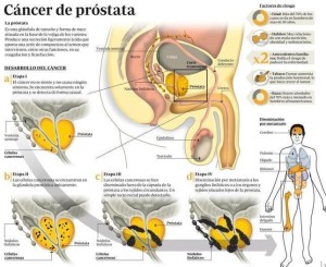 prostata--644x526